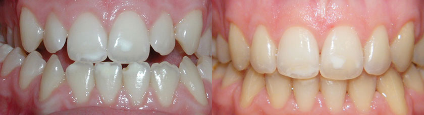 4 Premolar Extraction to Correct Crowding