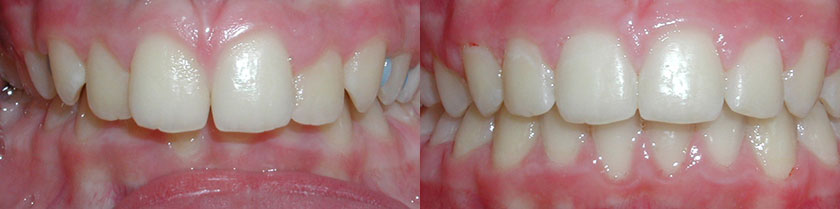 Deep Bite Correction (Non-Extraction)