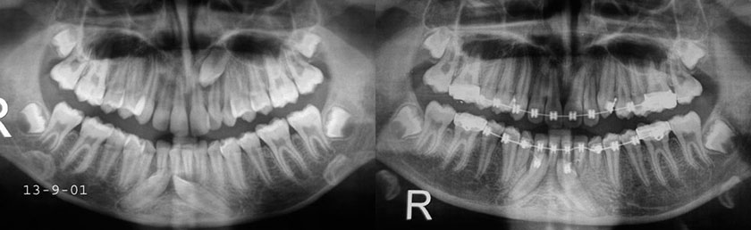 Impacted Canines