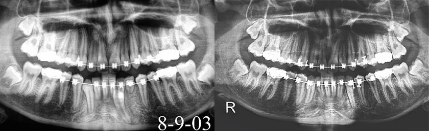 Impacted Canines