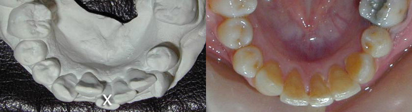 Lower Incisor Extraction