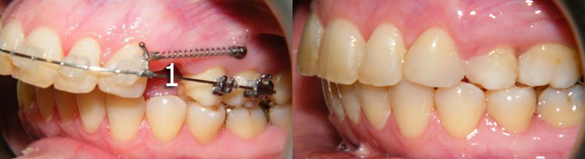 Overjet Reduction Using a Temporary Anchorage Device (TAD)