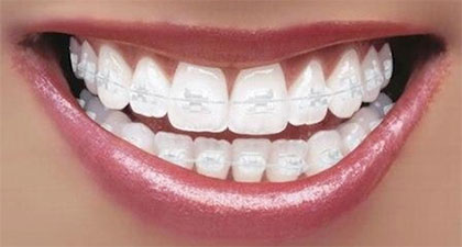 Ceramic Braces