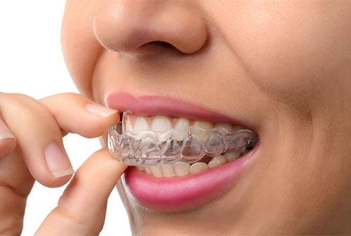 Invisalign®