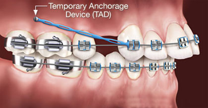 Temporary Anchorage Devices